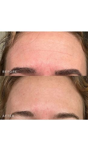 Máscara de la hoja forehead occlusion patch en color belleza: na talla all - Dermaclara - Modalova